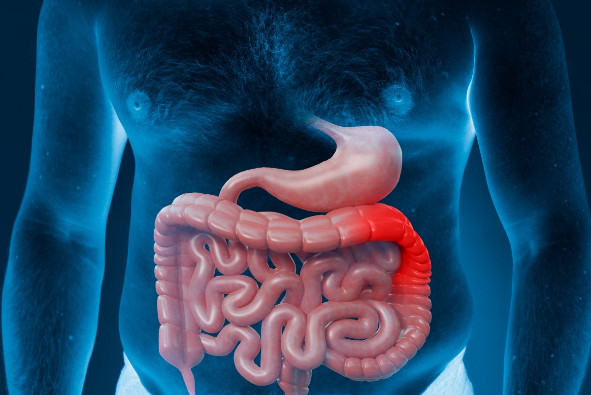 Come Capire Se Si Ha Il Morbo Di Crohn Quali Sono I Sintomi E Le Cure