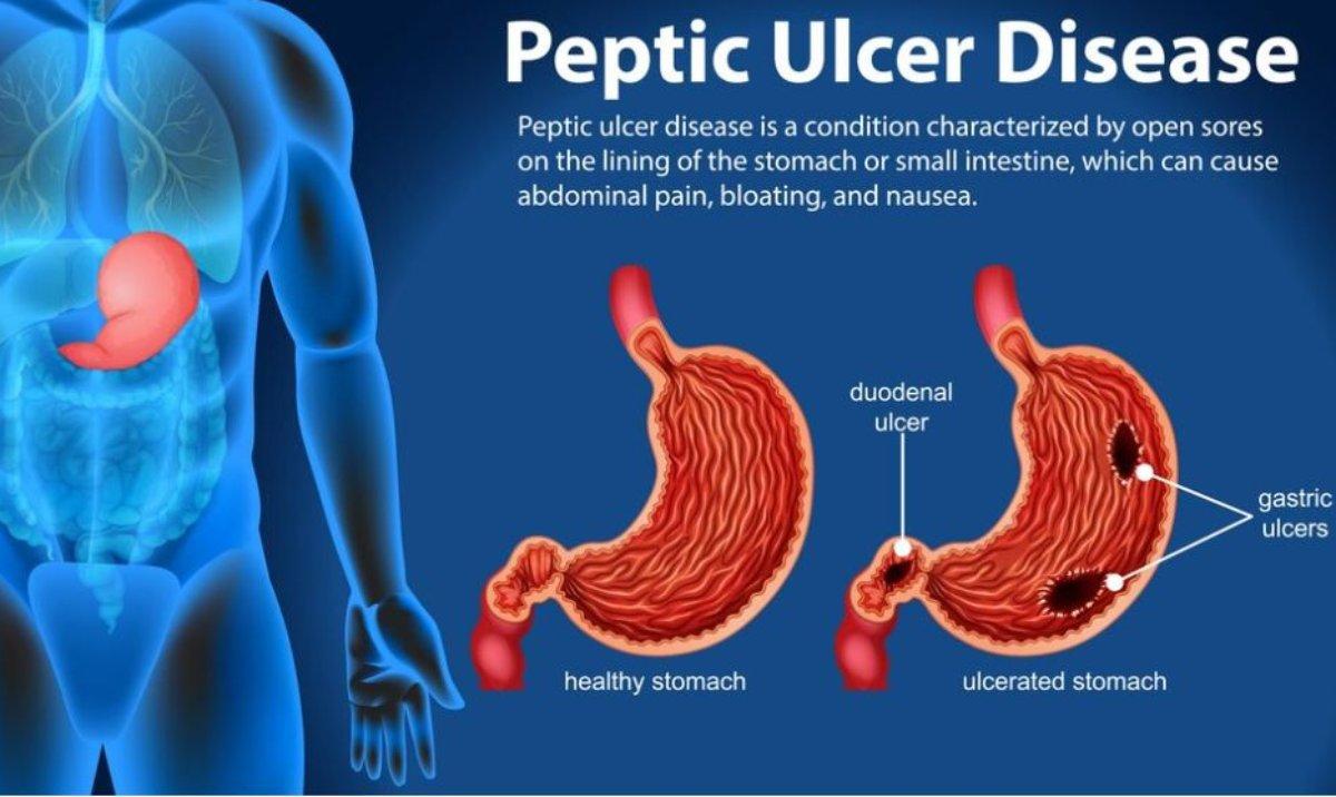 Come si cura l’ulcera peptica, quali sono i sintomi e come si diagnostica