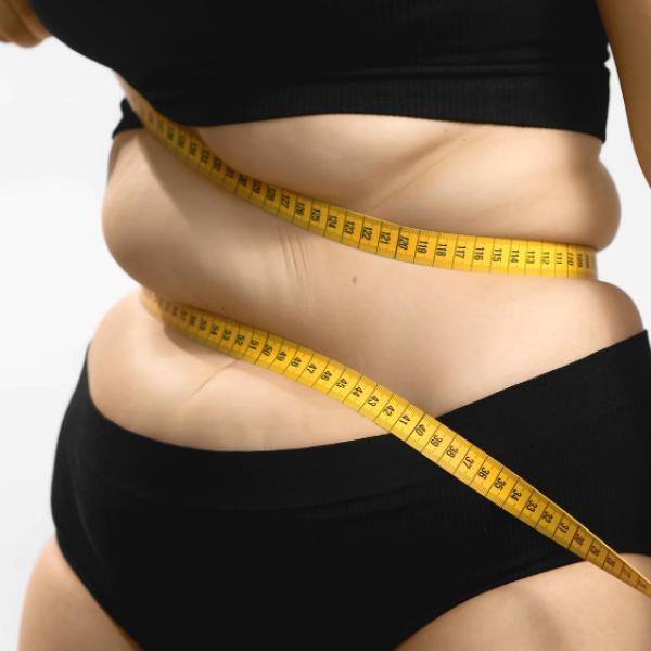 Che cos’è il lipedema e come riconoscerlo? Cure e cause