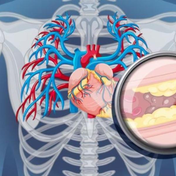 I sintomi delle coronarie ostruite, da cosa sono causate e come si curano