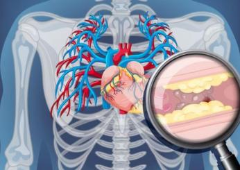I sintomi delle coronarie ostruite, da cosa sono causate e come si curano