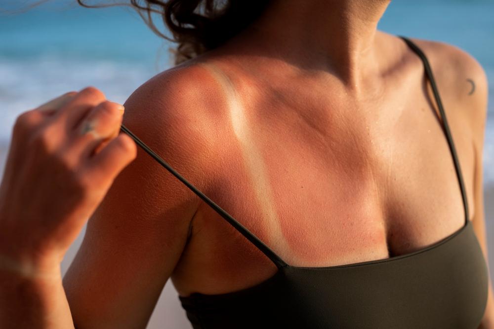 Come curare la pelle bruciata dal sole con i rimedi naturali?