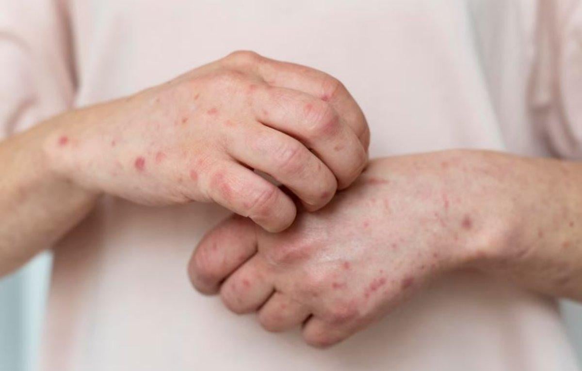 Lupus sintomi iniziali, come si scopre di averlo, quali sono le cur…