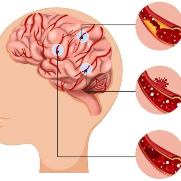 Quali sono i sintomi premonitori di un aneurisma, le conseguenze e le possibilità di sopravvivenza