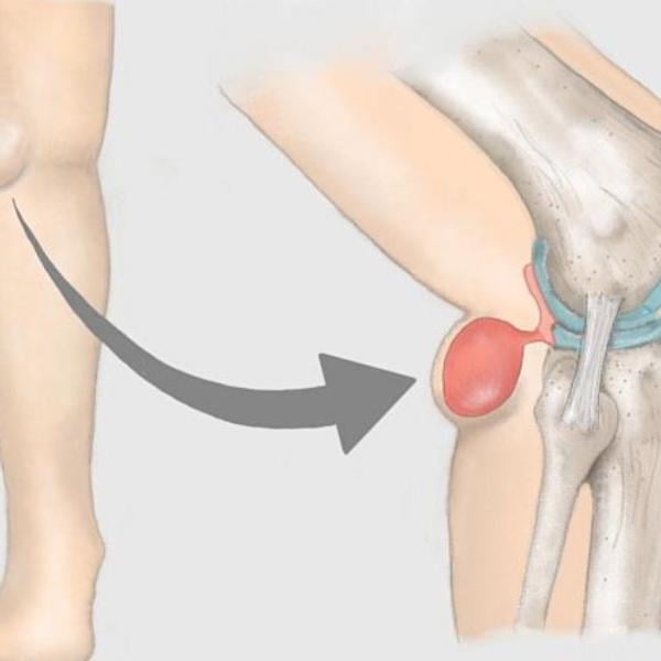 Che problemi può dare la cisti di Baker, come si cura e quando è necessario operarla