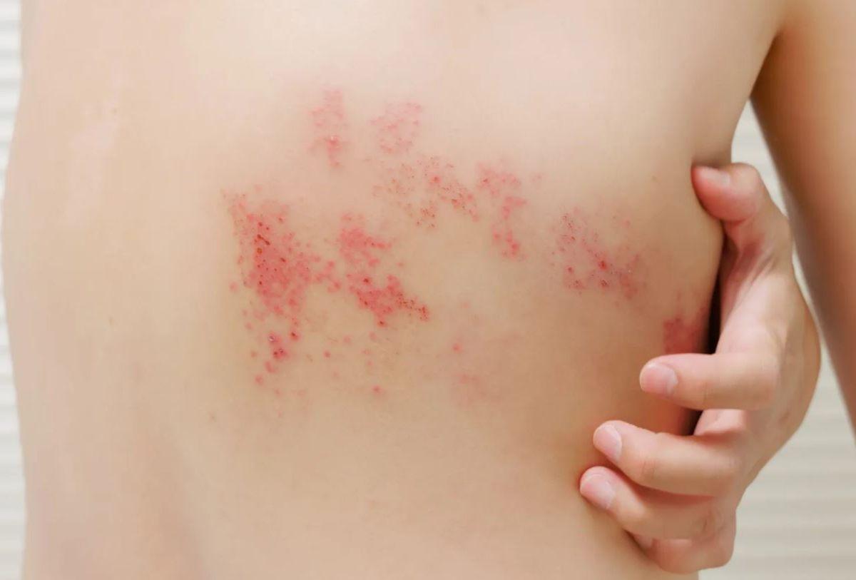 Fuoco di Sant’Antonio, perché si chiama così l’Herpes Zoster? Cause, sintomi iniziali, tempi di guarigione