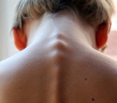 Melanoma metastatico, con la giusta sequenza terapeutica un paziente su due libero da malattia