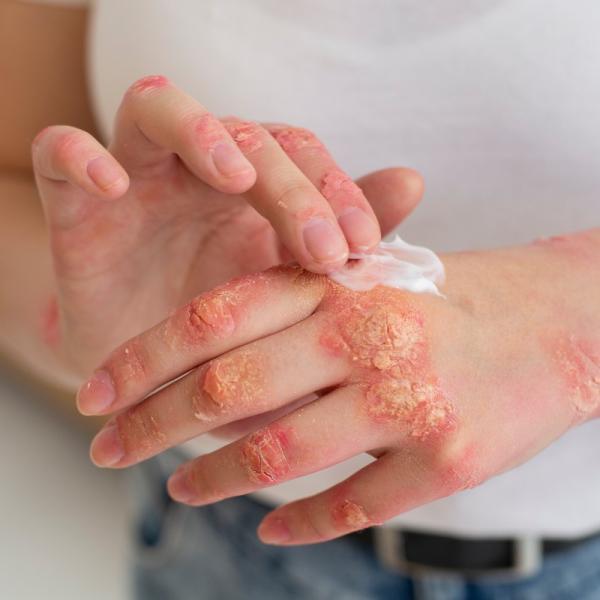 Come gestire un eczema quando fa troppo caldo