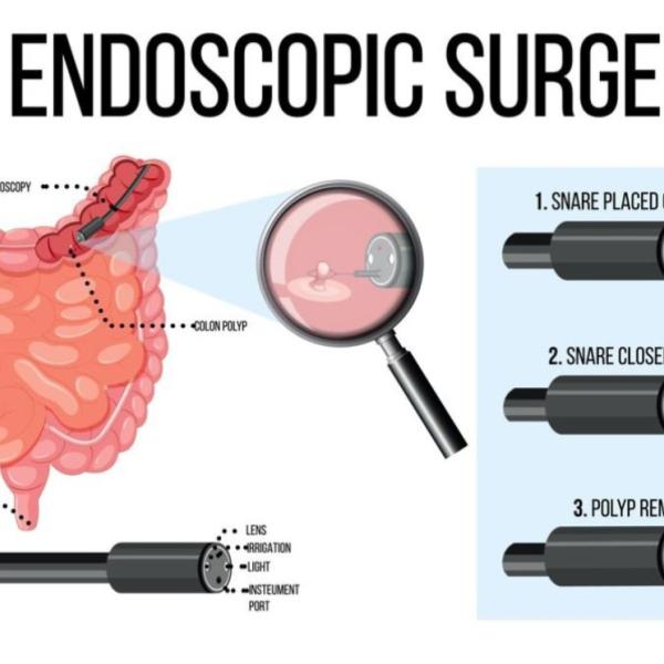 Endosleeve cos’è, come funziona, quali sono i risultati, i pro e i contro