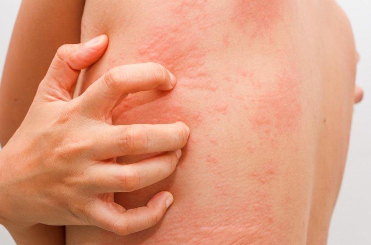 Cosa può scatenare l’orticaria, come farla passare e quali sono i rischi