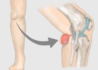 Che problemi può dare la cisti di Baker, come si cura e quando è necessario operarla