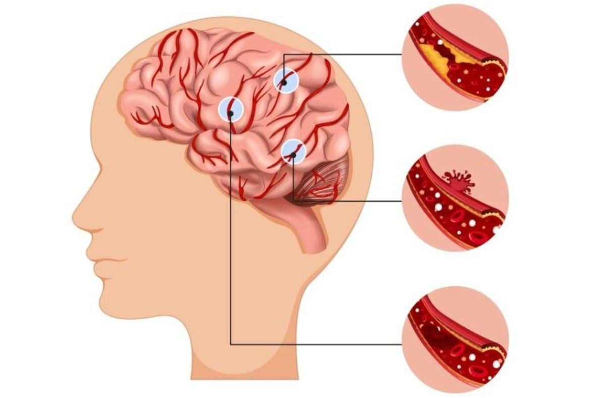 Quali sono i sintomi premonitori di un aneurisma, le conseguenze e …