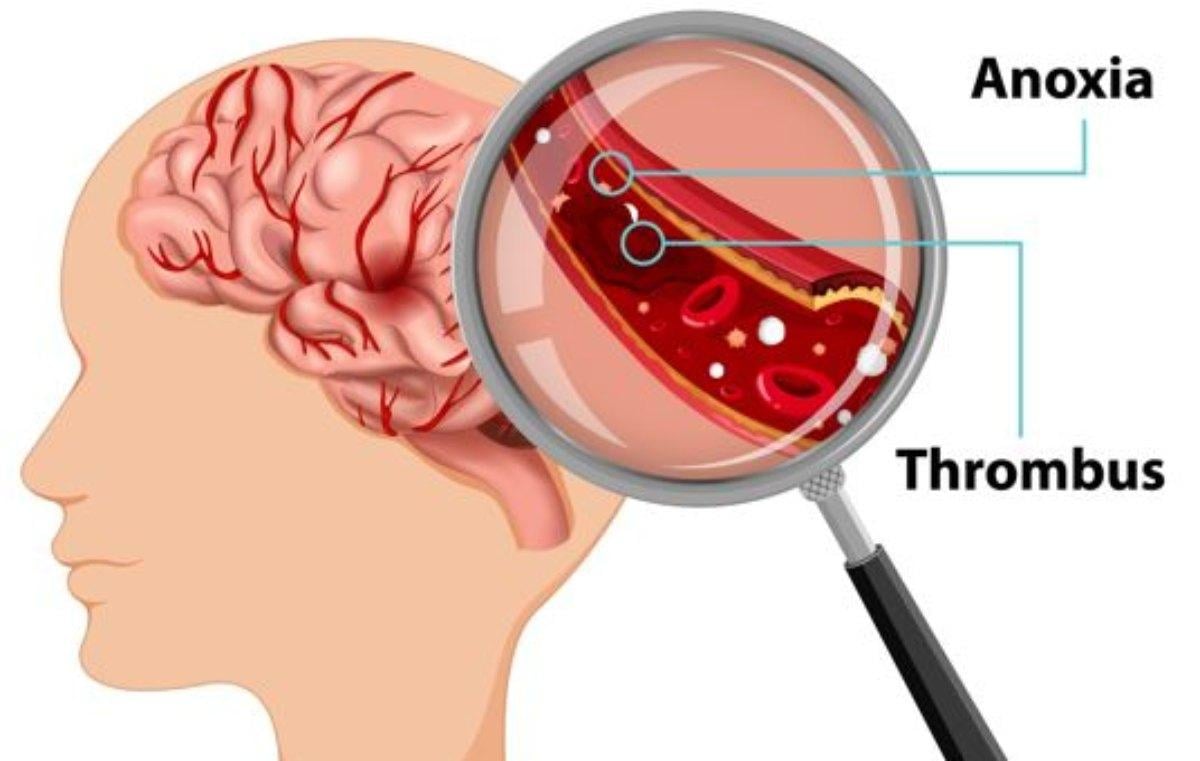 Cosa mangiare per prevenire un ictus? Ecco quali cibi scegliere e quanto spesso bisogna mangiare