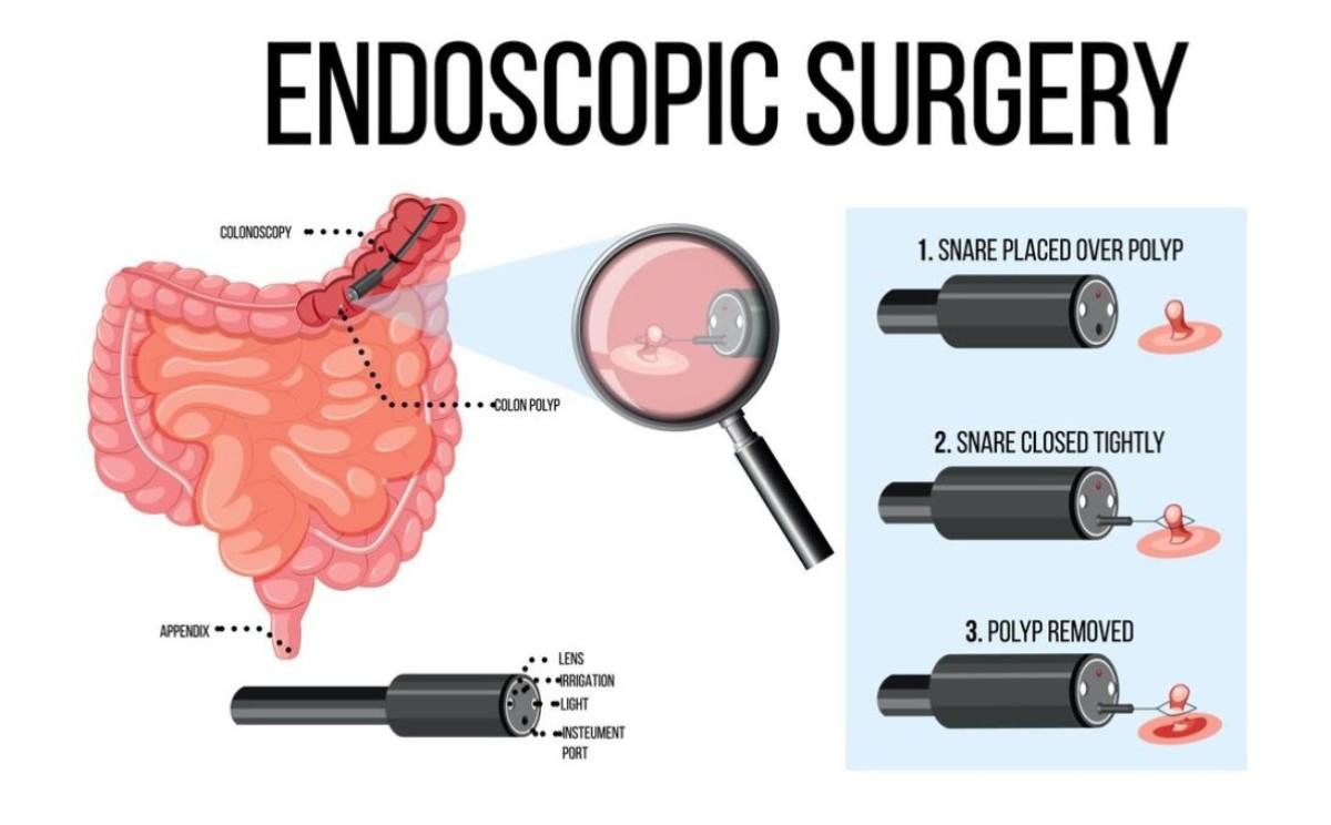 Endosleeve cos’è, come funziona, quali sono i risultati, i pro e i contro