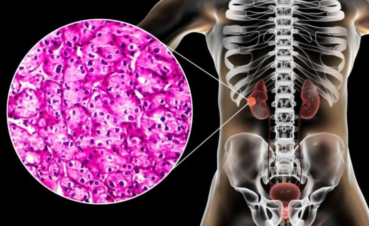 Quali sono i sintomi del tumore al rene e le nuove terapie disponibili