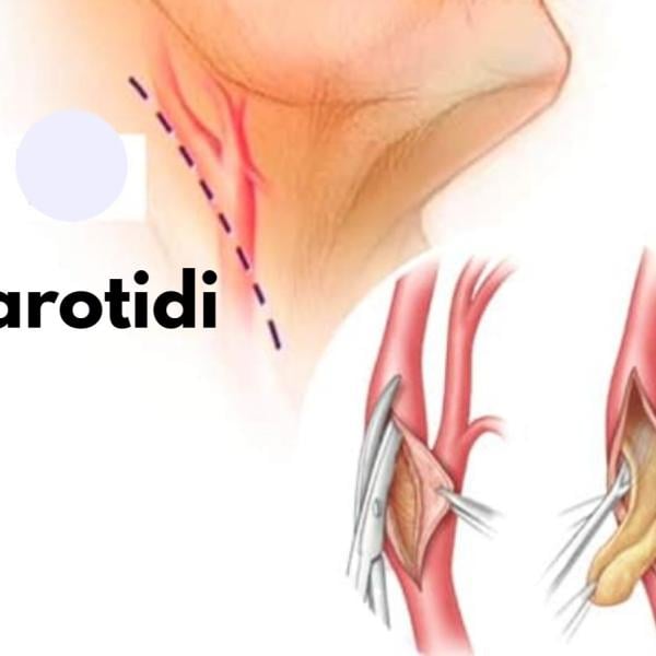 Cosa succede se si hanno le carotidi ostruite, quando preoccuparsi e quali sono i rischi