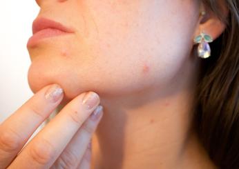 Acne rosacea: cos’è, cause, sintomi e terapia