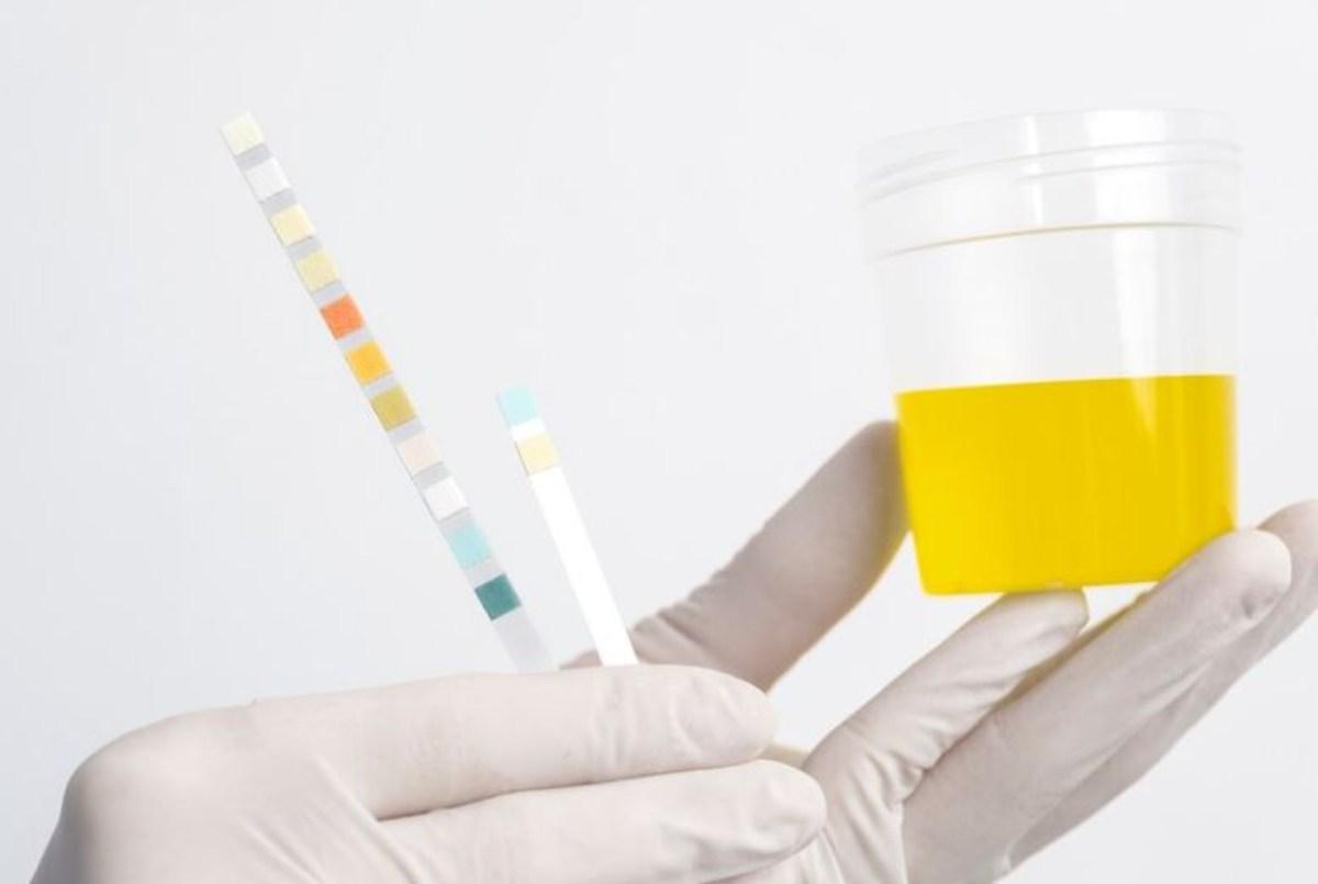 Scoperto nuovo test delle urine per diagnosticare cancro alla prostata aggressivo