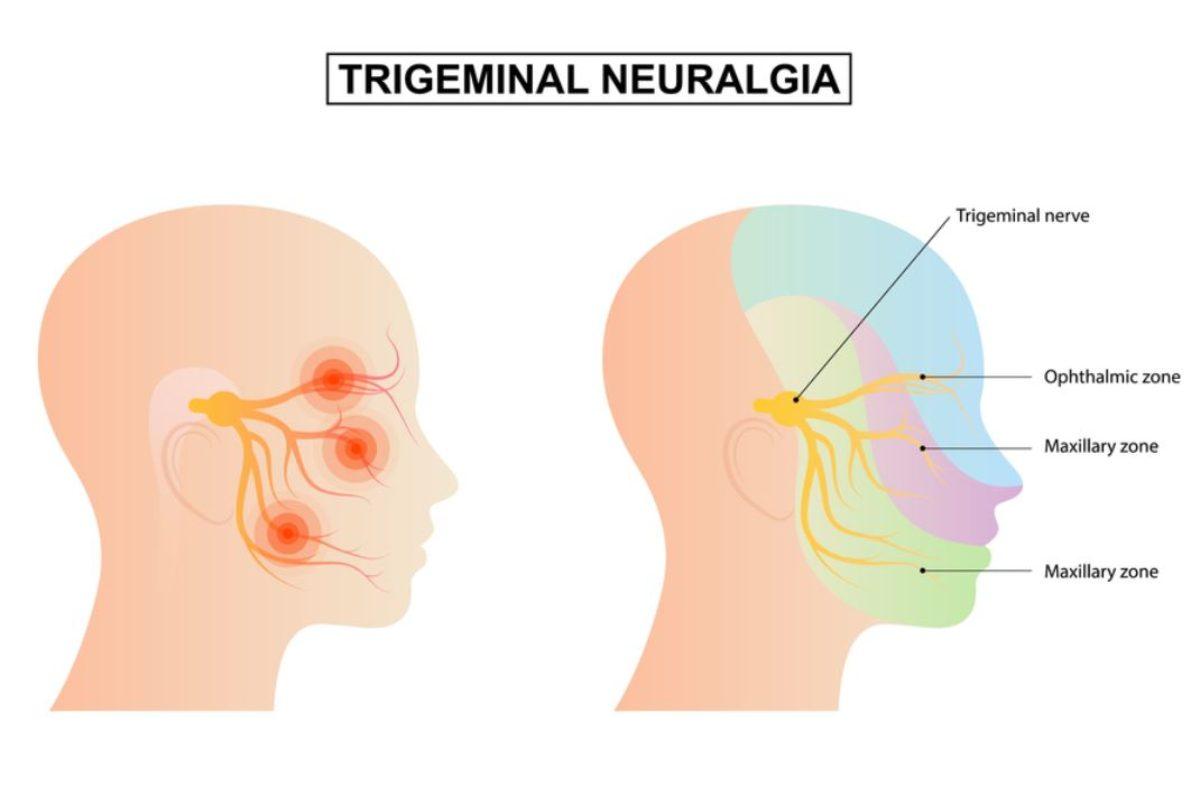 Come capire se si ha la nevralgia del trigemino, quali sono i sintomi e le cure