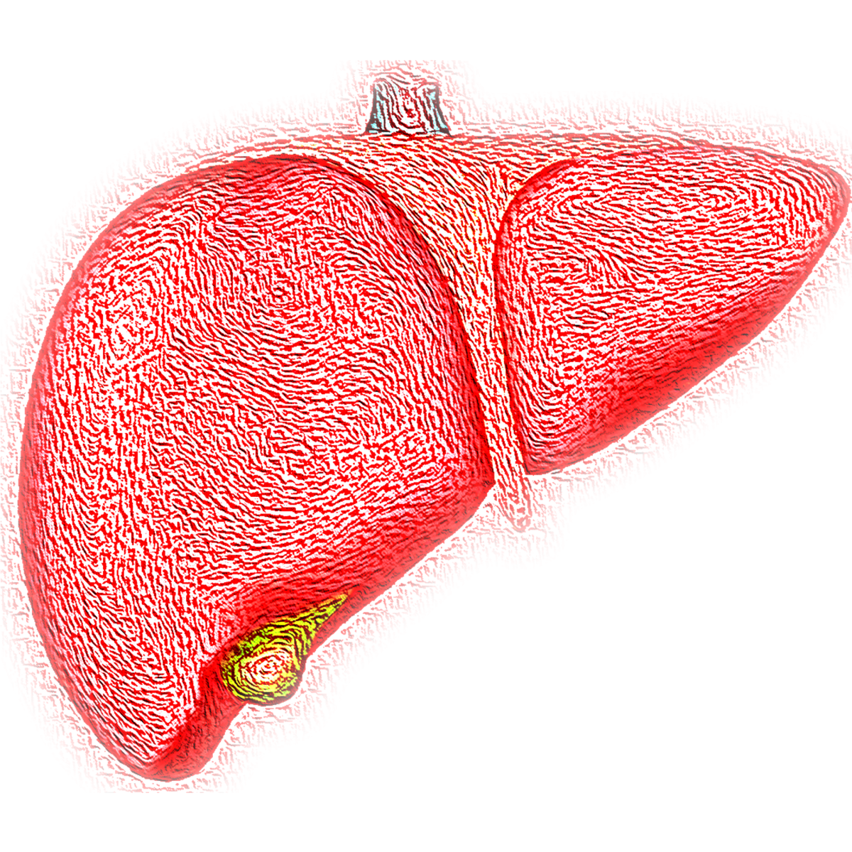 La fibrosi epatica cos’è e quando si manifesta? Tutto quello che c’…