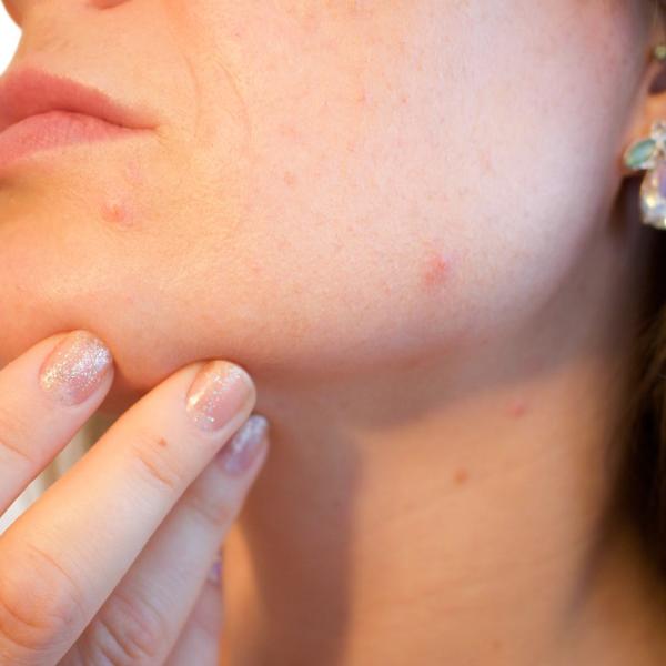 Acne rosacea: cos’è, cause, sintomi e terapia