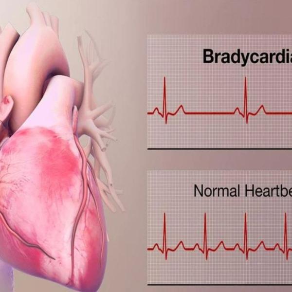 Quando la bradicardia sinusale è preoccupante e quali sono sintomi e cure