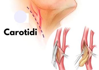 Cosa succede se si hanno le carotidi ostruite, quando preoccuparsi e quali sono i rischi