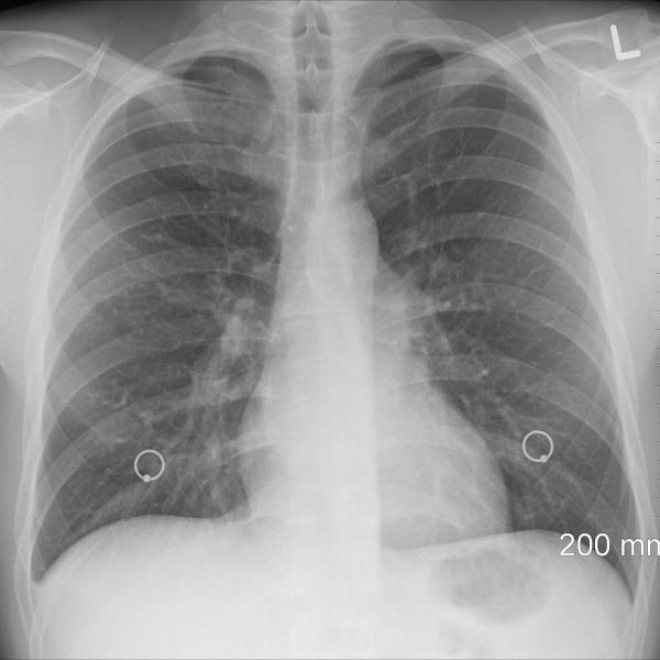 Indennità per malattia tubercolare: come funziona e come fare domanda all’INPS