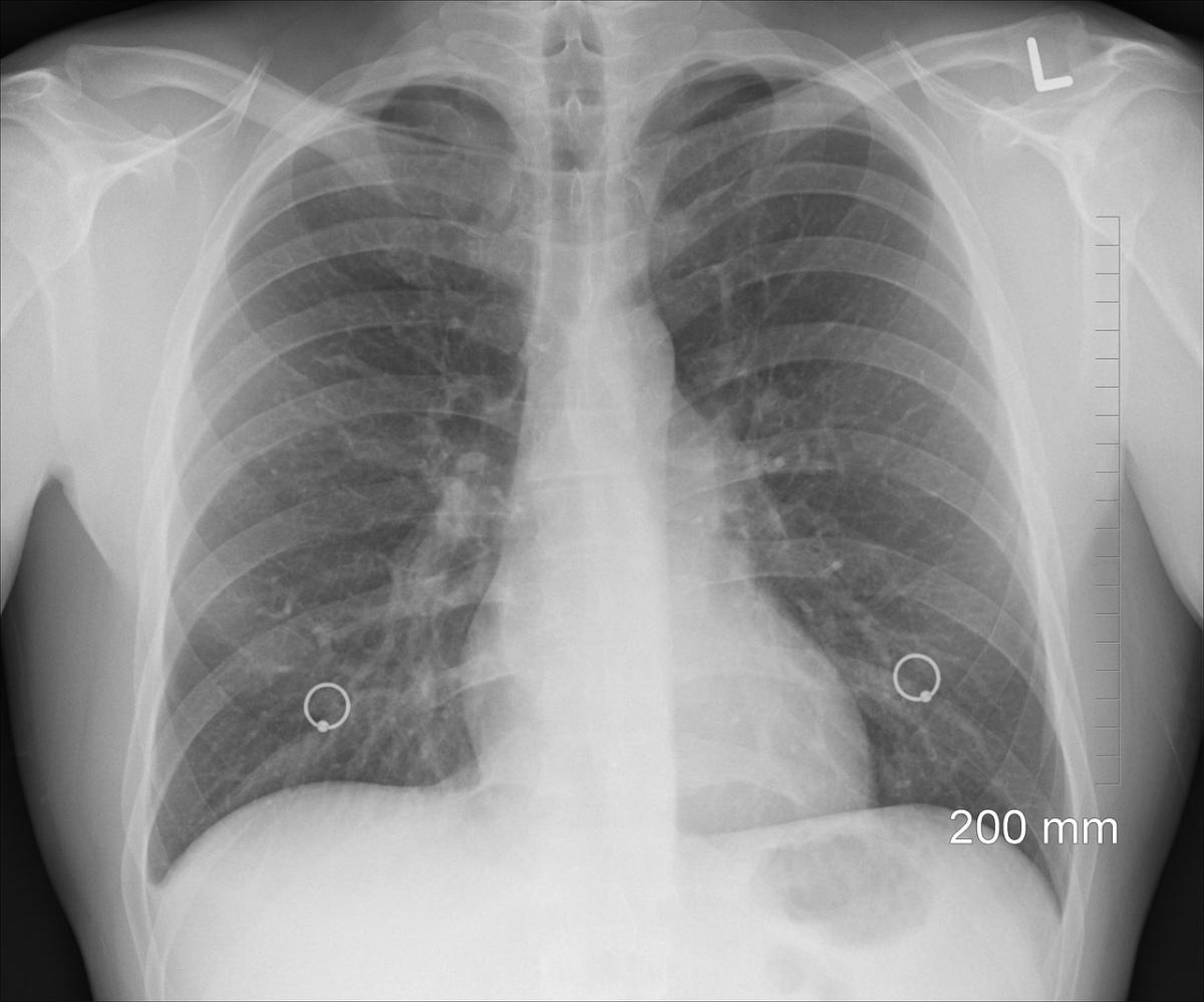 Indennità per malattia tubercolare: come funziona e come fare domanda all’INPS