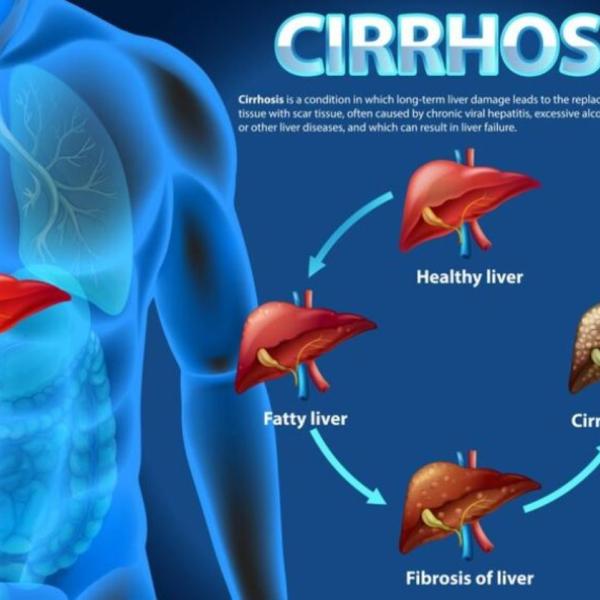 La cirrosi epatica è curabile? Quali sono i sintomi, da cosa è causata e quali possono essere le complicanze