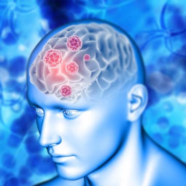 Nuova terapia cancella tumore incurabile al cervello, di cosa si tratta