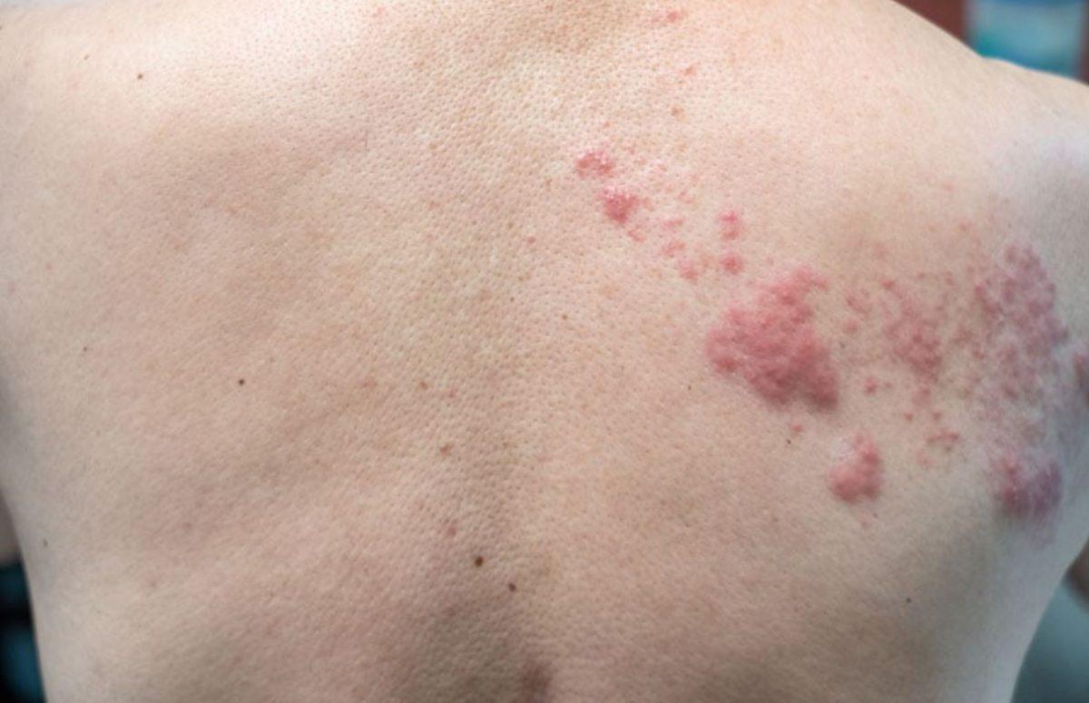 Come riconoscere e prevenire i sintomi dell’herpes zoster