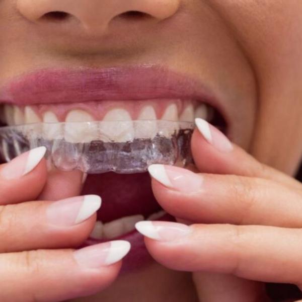 Digrignare i denti quali problemi può causare, a chi rivolgersi e cosa fare per smettere