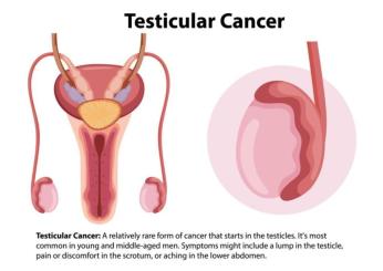 Tumore ai testicoli: sintomi iniziali e in stato avanzato, cause, mortalità e aspettativa di vita. Compromette l’erezione? Ecco quando preoccuparsi