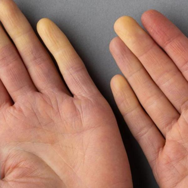 Cos’è la sindrome di Raynaud, come si diagnostica, quali sono le conseguenze e le cure