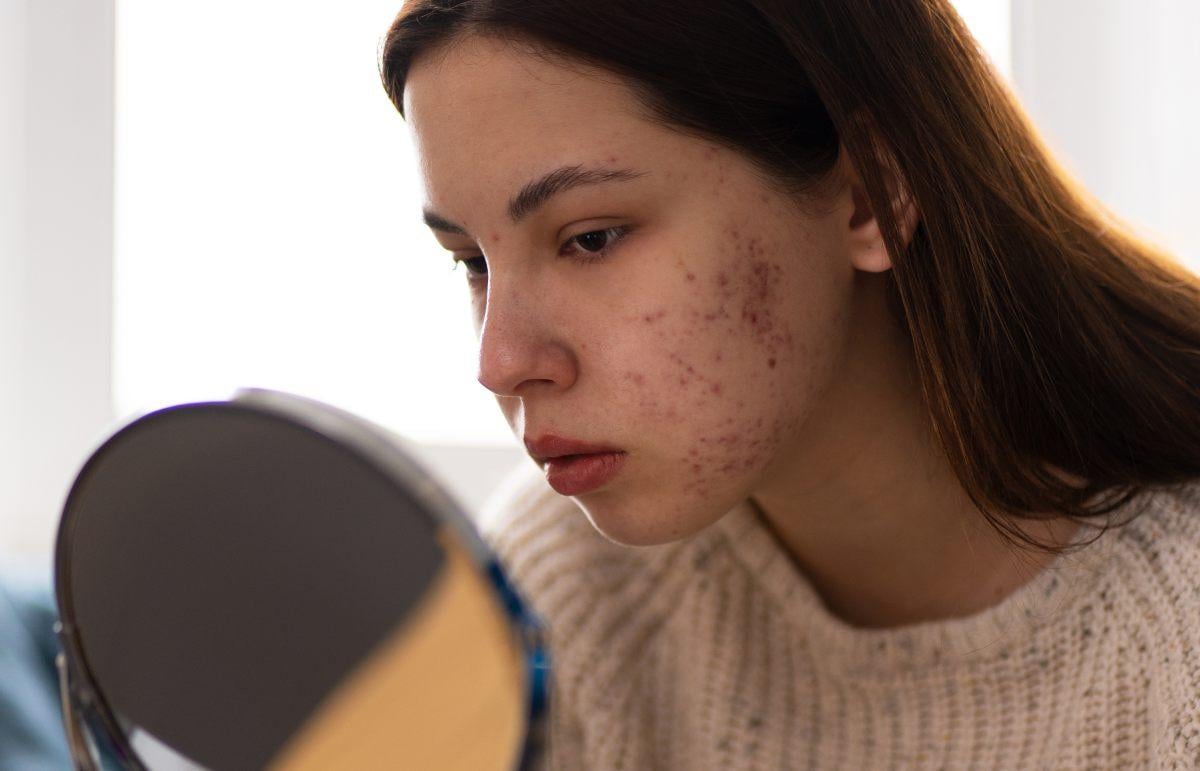 Quanti tipi di acne esistono e cosa fare in ogni specifico caso