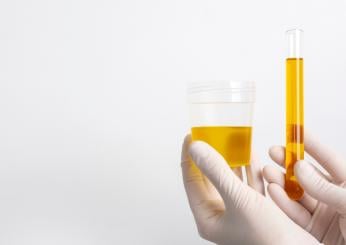 Cosa non fare prima dell’esame delle urine: come si fa e raccolta