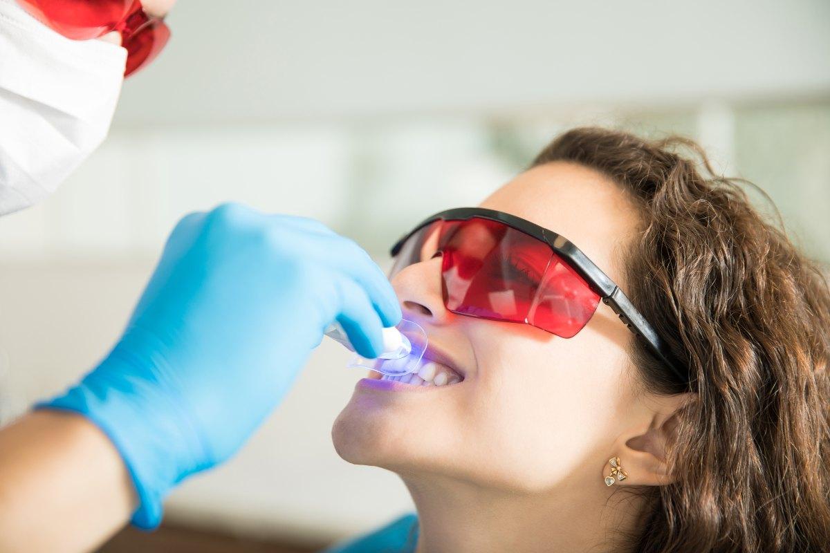 Lo sbiancamento dei denti è dannoso? In cosa consiste e quali sono le controindicazioni