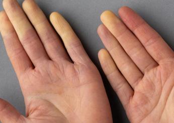 Cos’è la sindrome di Raynaud, come si diagnostica, quali sono le conseguenze e le cure