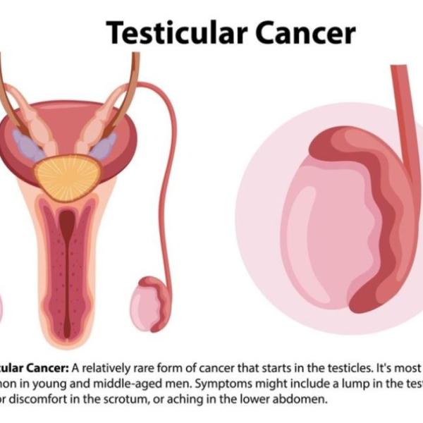 Tumore ai testicoli: sintomi iniziali e in stato avanzato, cause, mortalità e aspettativa di vita. Compromette l’erezione? Ecco quando preoccuparsi