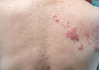 Come riconoscere e prevenire i sintomi dell’herpes zoster