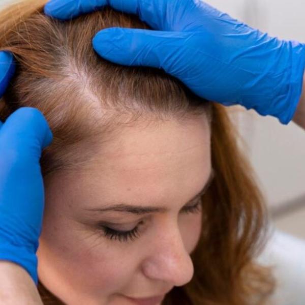 Cosa fare in caso di alopecia femminile, come arrestare la caduta dei capelli e a chi rivolgersi