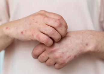 Lupus sintomi iniziali, come si scopre di averlo, quali sono le cure e quanto si può vivere