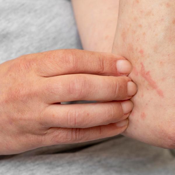 Consigli quotidiani per alleviare l’eczema e trovare sollievo