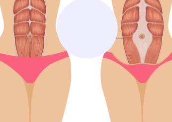 Come capire se si soffre di diastasi addominale, come si cura e quando è necessario l’intervento