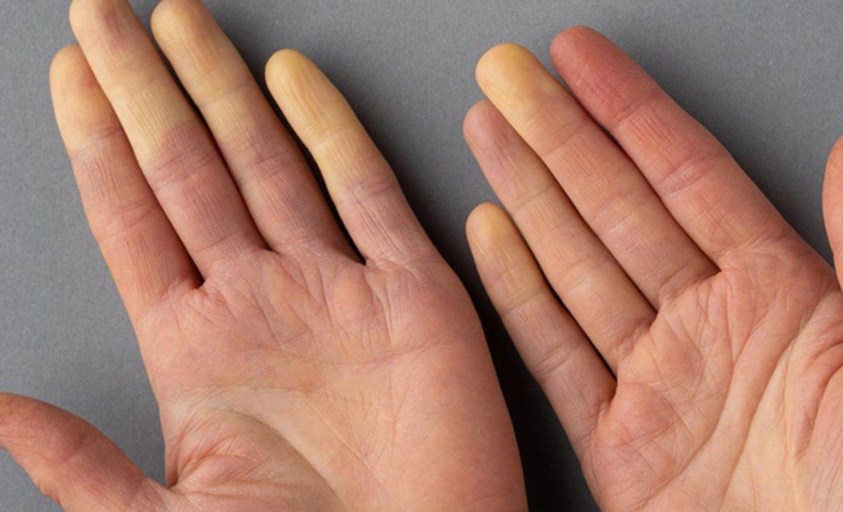 Cos’è la sindrome di Raynaud, come si diagnostica, quali sono le conseguenze e le cure