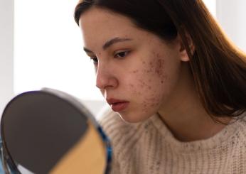 Quanti tipi di acne esistono e cosa fare in ogni specifico caso