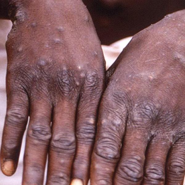 Vaiolo delle scimmie, perché l’Africa dichiara emergenza sanitaria e da dove è partita l’epidemia?