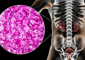 Quali sono i sintomi del tumore al rene e le nuove terapie disponibili