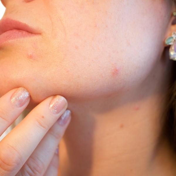 Cosa mangiare per combattere l’acne